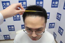 -大麦微针植发丨全国连锁