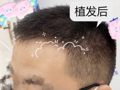 -大麦微针植发全国连锁