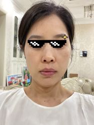 体验后-广州健丽·去眼袋医疗美容机构