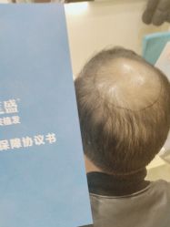 -碧莲盛·不剃发植发