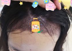 -大麦微针植发全国连锁