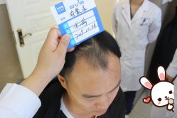 -大麦微针植发丨全国连锁