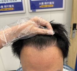 体验后-大麦微针植发全国连锁