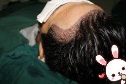 -大麦微针植发丨全国连锁