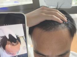 -碧莲盛·不剃发植发