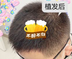 -大麦微针植发全国连锁