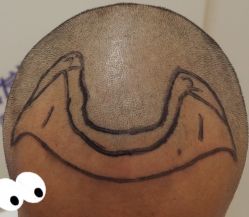 -大麦微针植发全国连锁