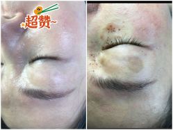 -美丽人生祛斑扁平疣汗管瘤中心