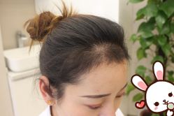 -大麦微针植发丨全国连锁