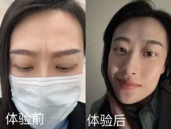 体验前-深圳美莱医疗美容医院