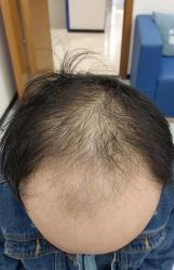 体验前-大麦微针植发全国连锁