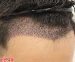 -大麦微针植发丨全国连锁