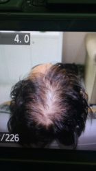 体验前-大麦微针植发全国连锁