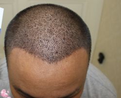 -大麦微针植发丨全国连锁