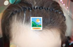 -大麦微针植发全国连锁