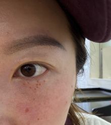 -爱莎扁平疣·汗管瘤·斑痣中心