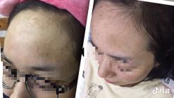 -一次性洗纹身·修复疤痕·超皮秒