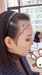 点击看大图 -大麦微针植发丨全国连锁