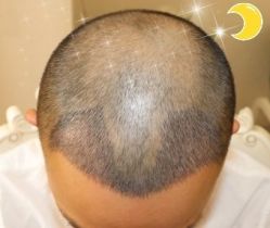 -大麦微针植发丨全国连锁