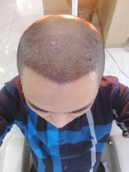 点击看大图 -大麦微针植发丨全国连锁