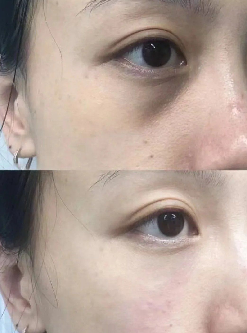 眼袋 黑眼圈 泪沟你清楚吗?