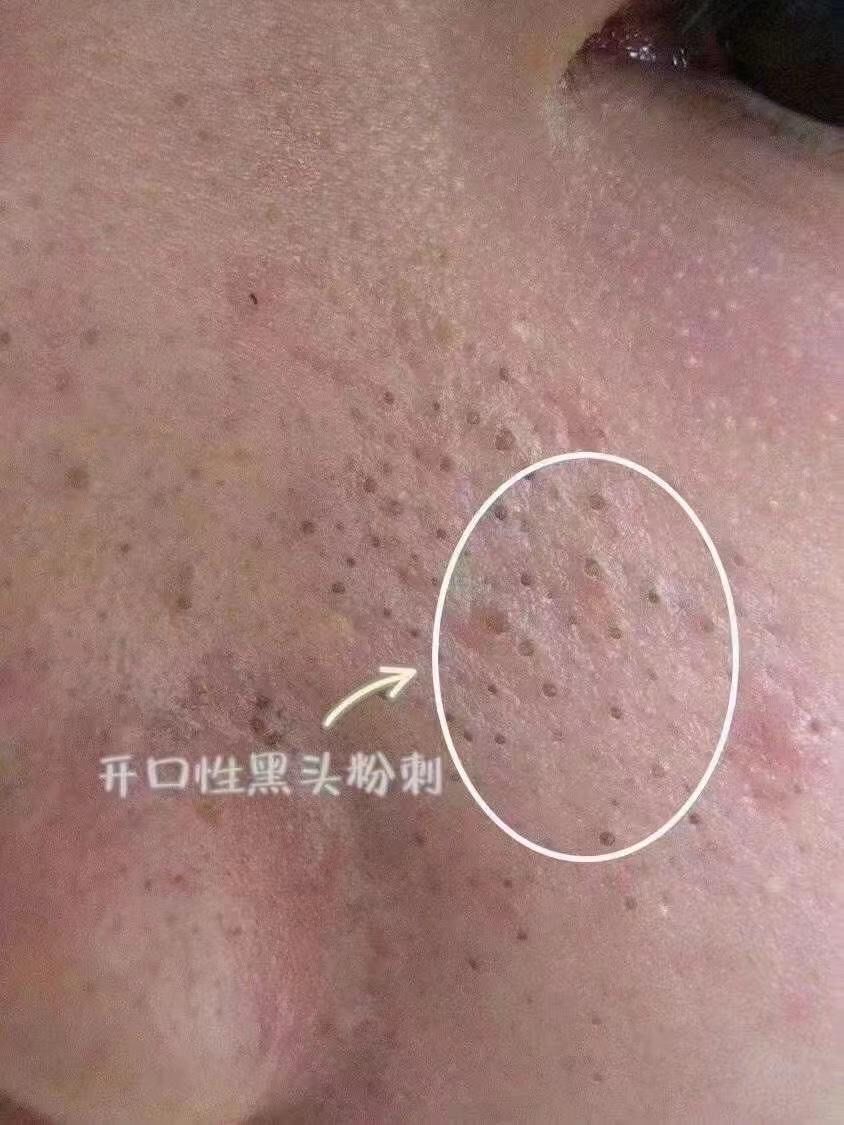 ||暑假季
孩子们脸上浅浅的闭口
这时不管