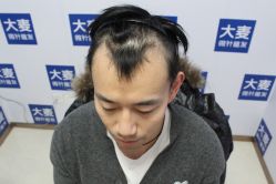 -大麦微针植发丨全国连锁