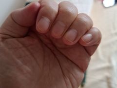 -Andrew指甲专科灰指甲·甲沟炎矫正·3D步态矫形鞋垫定制(上海法华镇路旗舰店)