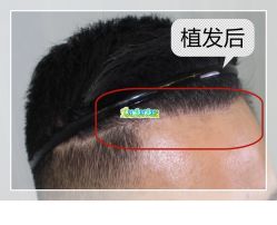 -大麦微针植发全国连锁