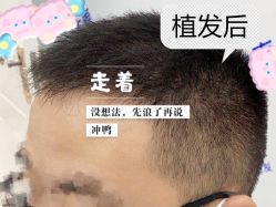 -大麦微针植发全国连锁