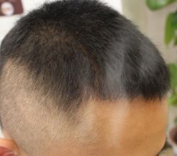 -大麦微针植发丨全国连锁