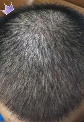 -大麦微针植发丨全国连锁