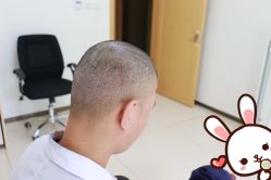 -大麦微针植发丨全国连锁