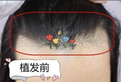 -大麦微针植发全国连锁