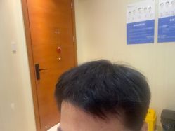 -碧莲盛·不剃发植发