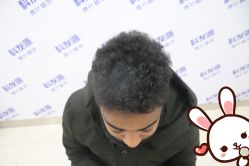 -大麦微针植发丨全国连锁