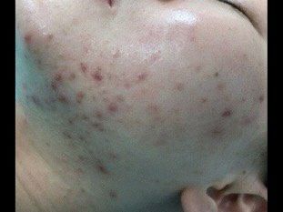 体验前-成都苗方清颜专业祛痘