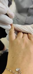 -德哥灰指甲脚气甲沟炎跖疣护理