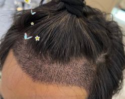 -大麦微针植发全国连锁