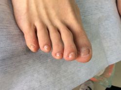 -德哥灰指甲脚气甲沟炎跖疣护理