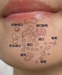 -瑶芳清颜草本祛痘
