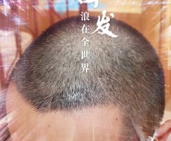 -大麦微针植发全国连锁