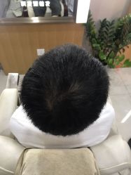 点击看大图 -大麦微针植发全国连锁