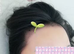 -大麦微针植发全国连锁