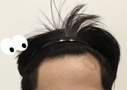 -大麦微针植发全国连锁