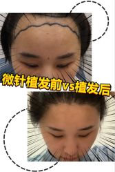 -大麦微针植发全国连锁
