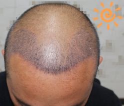 -大麦微针植发丨全国连锁