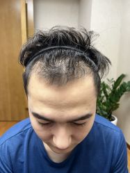 体验前-大麦微针植发全国连锁