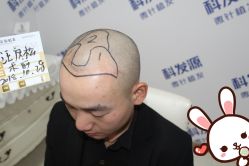 点击看大图 -大麦微针植发丨全国连锁