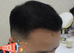 -大麦微针植发丨全国连锁